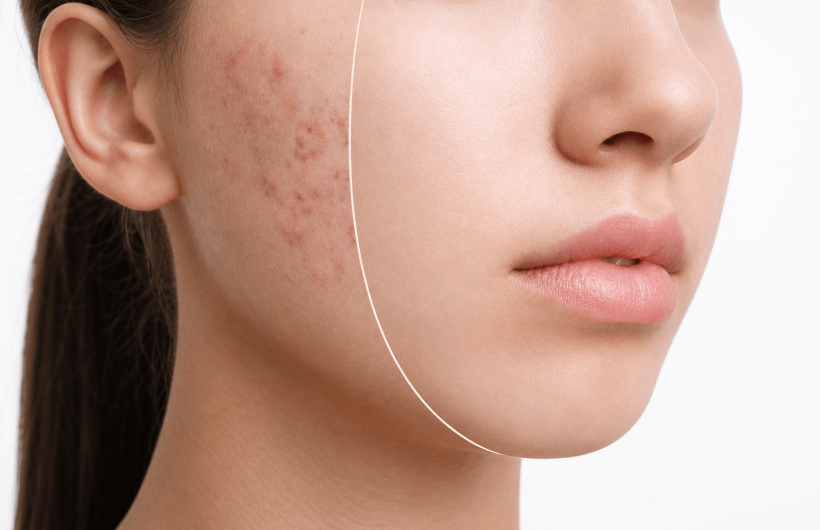 Desde $22.50: Faciales